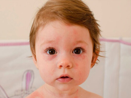 علل حساسیت‌های پوستی در کودکان چیست؟