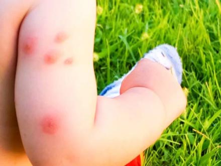 حساسیت در کودکان چگونه درمان می‌شود؟