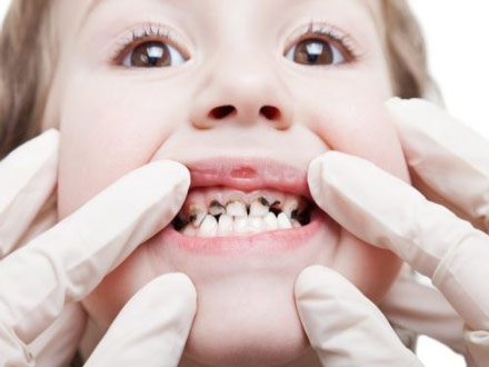 آیا مراقبت از دندان‌های شیری اهمیت دارد؟
